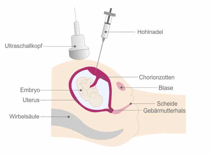 Chorionzottenbiopsie