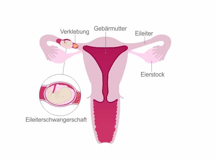 Eileiterschwangerschaft